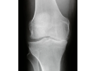 Diagnostic de l'arthrose de l'articulation du genou