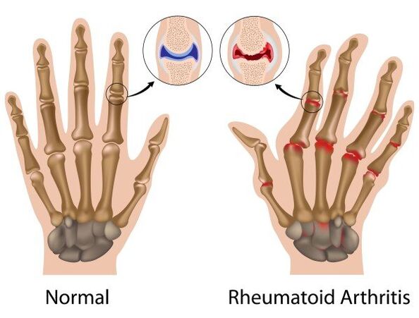 Dita articulations sans pathologie et avec la polyarthrite rhumatoïde