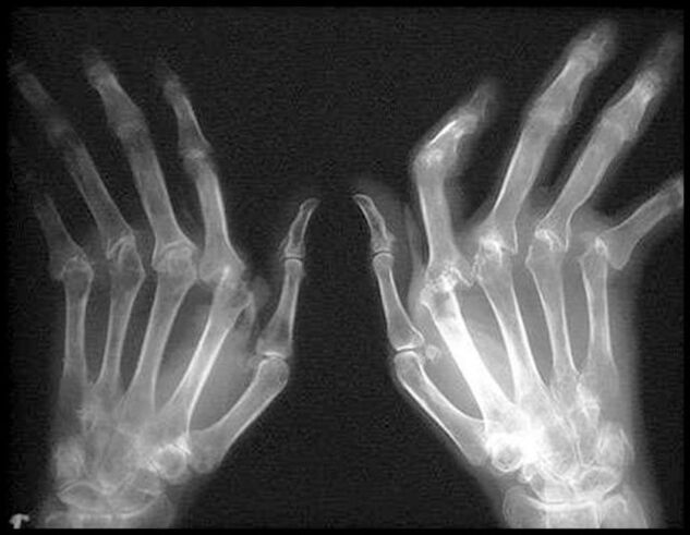 Mains en quadrage affectées par l'arthrose