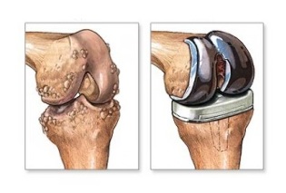 arthroplastie du genou pour l'arthrose