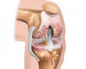 le stade initial de l'arthrose du genou