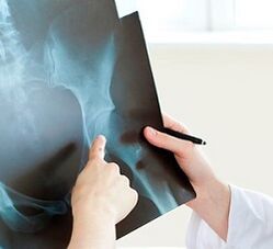 Comment traiter l'arthrose de l'articulation de la hanche