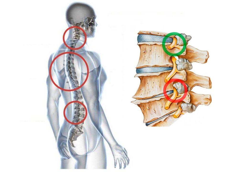 Comment apparaît l'ostéochondose cervicale des vertèbres