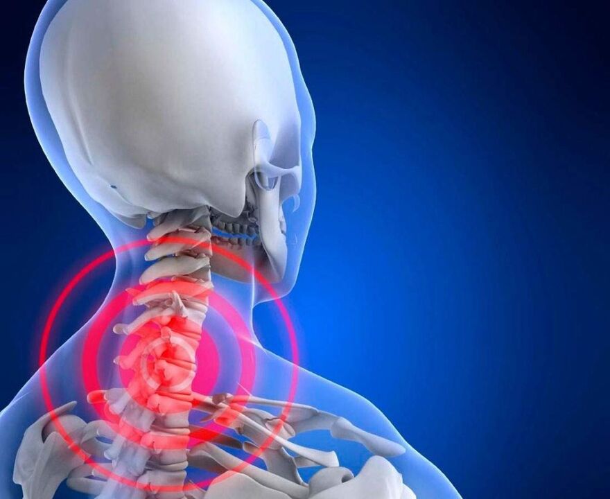 Douleurs au cou avec l'ostéochondose cervicale
