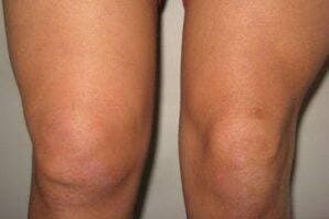 inflammation de l'articulation du genou avec arthrite et arthrose