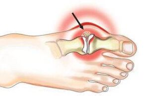 lésions articulaires dues à l'arthrite et à l'arthrose