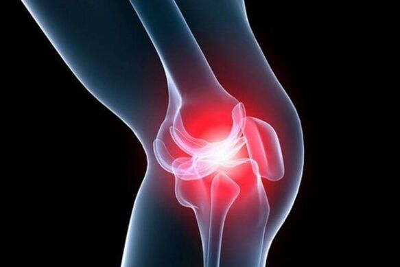 arthrose de l'articulation du genou