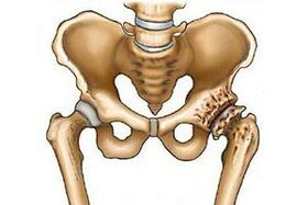 destruction de l'articulation de la hanche dans l'arthrose